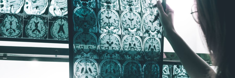 inicio temprano del alzheimer